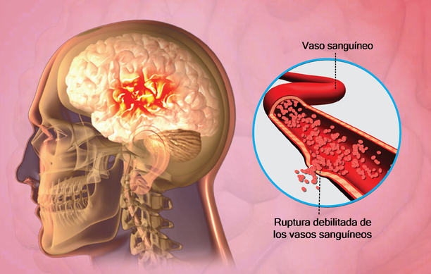 Accidente cerebro-vascular